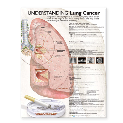 Understanding Lung Cancer Anatomical Chart Paper Unmounted | Zookal Textbooks | Zookal Textbooks