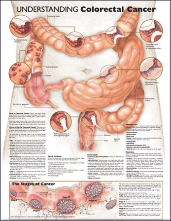 Understanding Colorectal Cancer Anatomical Chart Company        Laminated | Zookal Textbooks | Zookal Textbooks