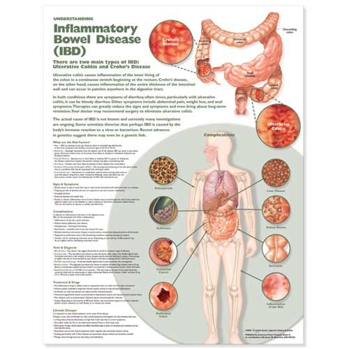 Understanding Inflammatory Bowel Disease (IBD) Anatomical Chart Paper Unmounted | Zookal Textbooks | Zookal Textbooks