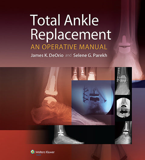 Total Ankle Replacement:  An Operative Manual | Zookal Textbooks | Zookal Textbooks